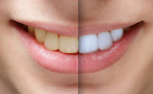 San Tan Valley Dentist. Keep Teeth White After Whitening