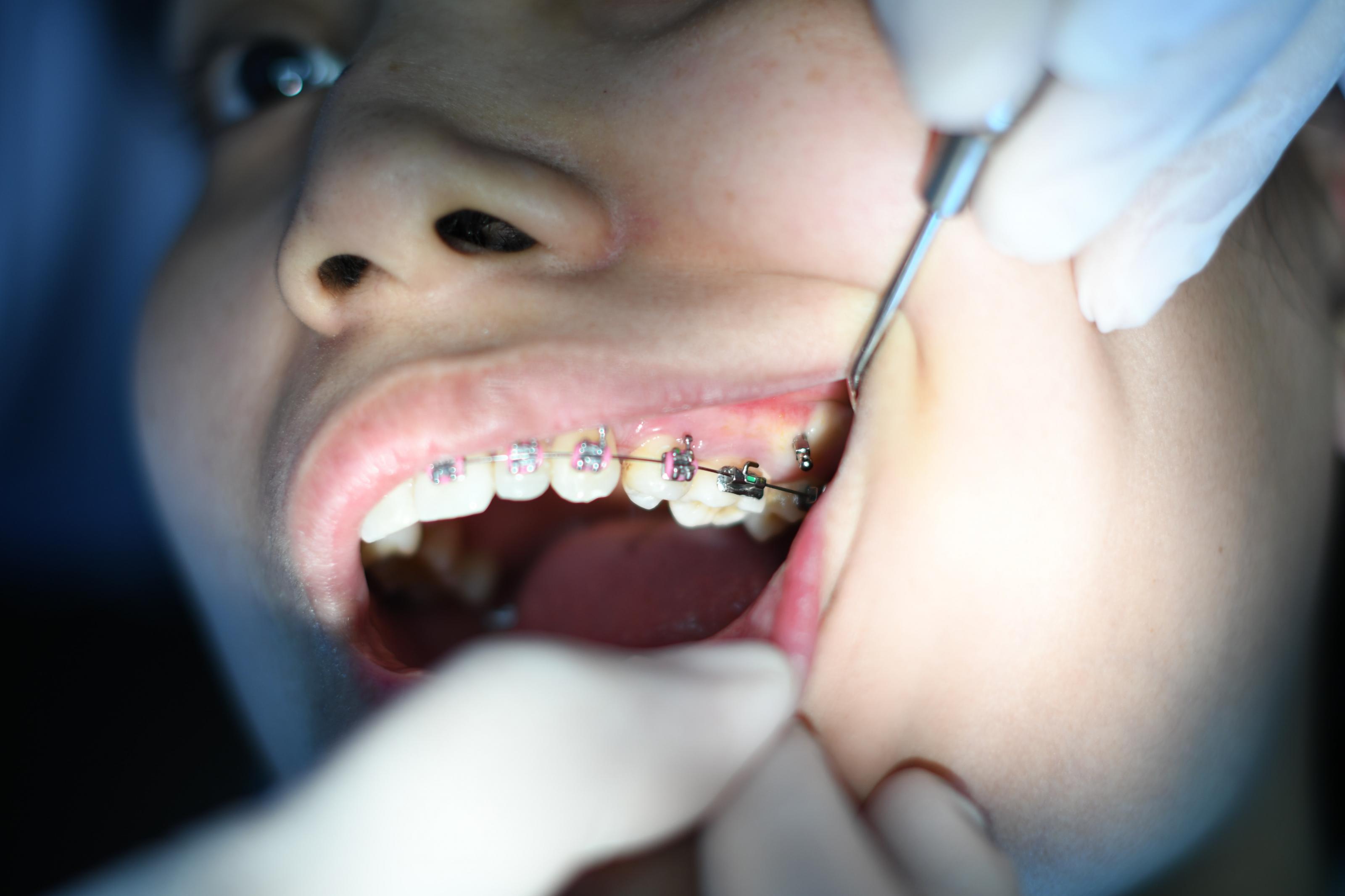 Kids Dentist Queen Creek, AZ. What Braces Can Dentists Fit?