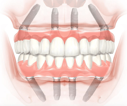 Get the Best Dental Implants in Mesa, AZ