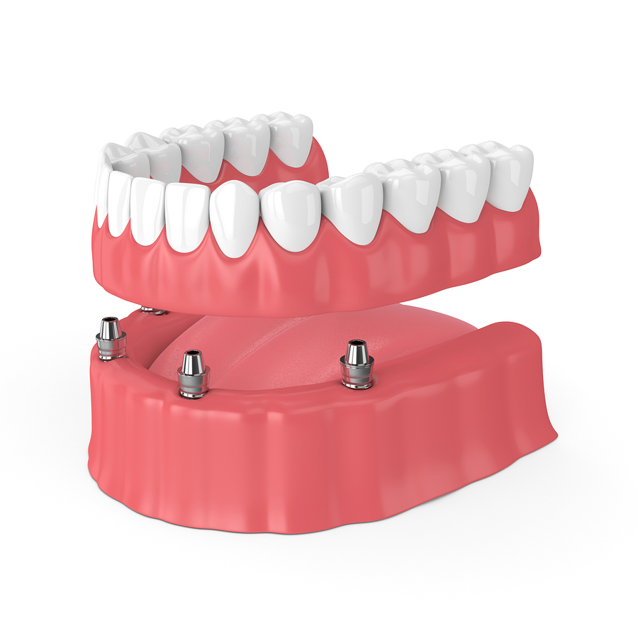 Dental Implants and Queen Creek Cosmetic Dentist