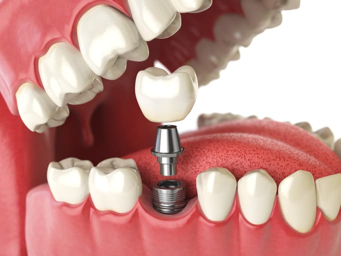Implants and Gilbert Family Dentistry