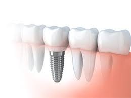 All on 4 Paradise Valley AZ Implants