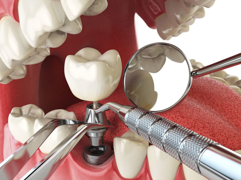 Get The Best Implant Treatment From Queen Creek Cosmetic Dentist