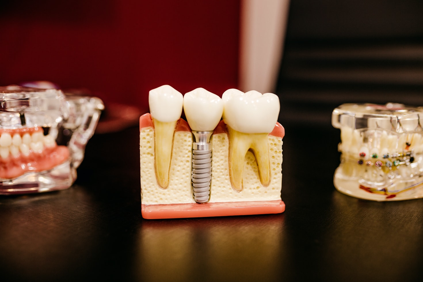 Mesa Affordable Dental Crown. How to Fix Broken Teeth