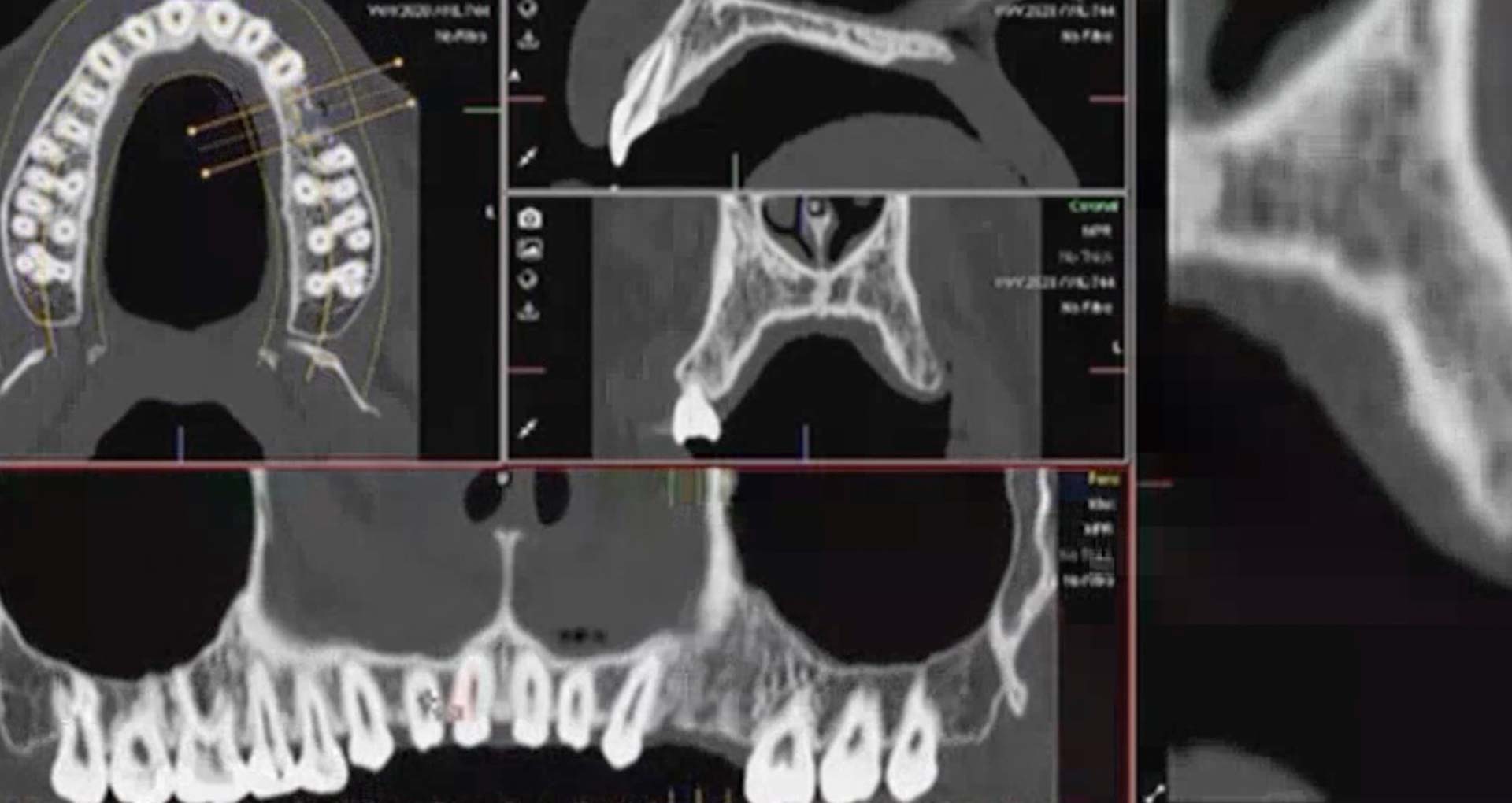 Apache Junction Dentist. Are Dental X-Rays Safe?