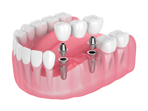 Dental Bridge