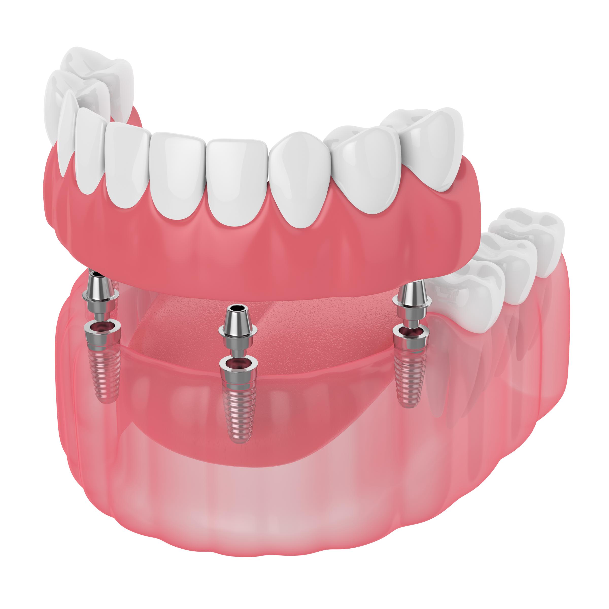 Dental Bridges For Broken Teeth? Chandler, AZ Cosmetic Dentist