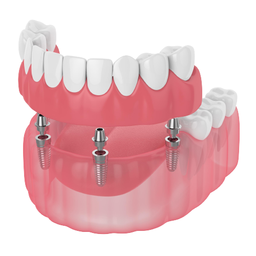 Strengthen Teeth with Martin Dental Affordable Dental